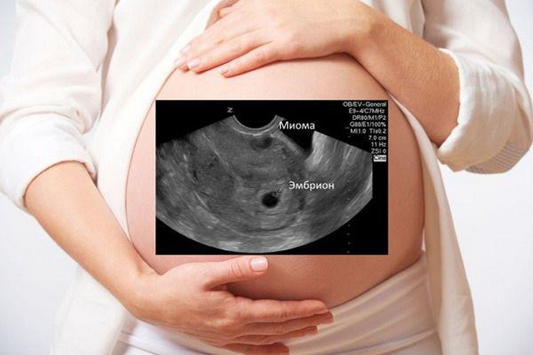 Как протекает беременность при миоме?