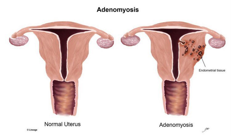 В чем опасность симбиоза миомы матки и аденомиоза?