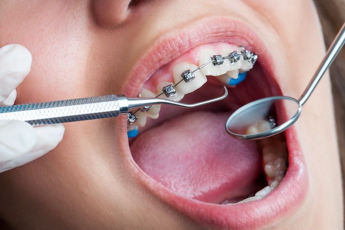 Причины появления кривизны зубов после лечения брекетами