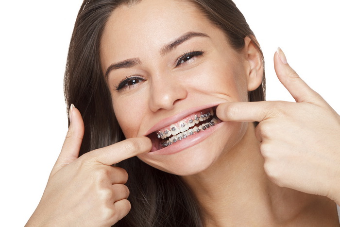 Выравнивание зубов брекет-системами