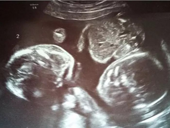 История за минуту-близнецы обнимаются в утробе матери