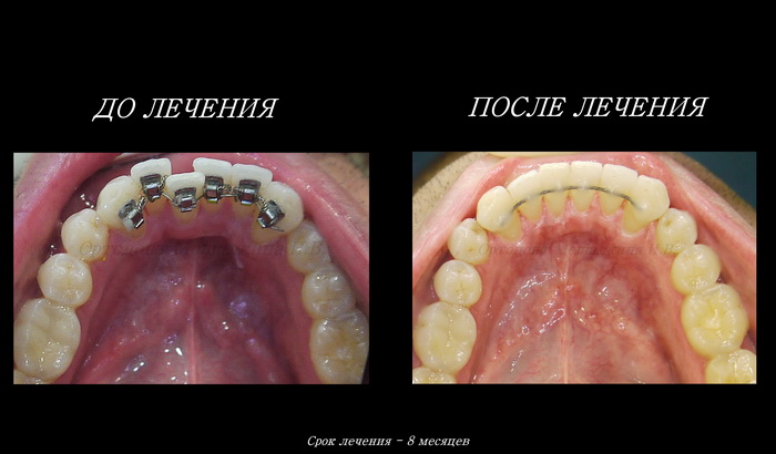 До и после лечения лингвальными брекет-системы