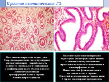 Гиперплазия эндометрия под микроскопом