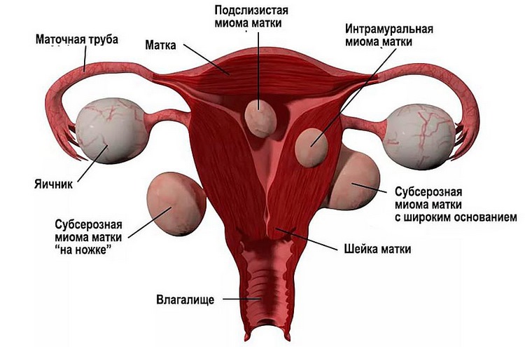Особенности диагностики и лечения миомы матки интрамуральной формы