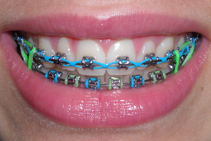 color braces