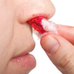 Кровотечение из носа