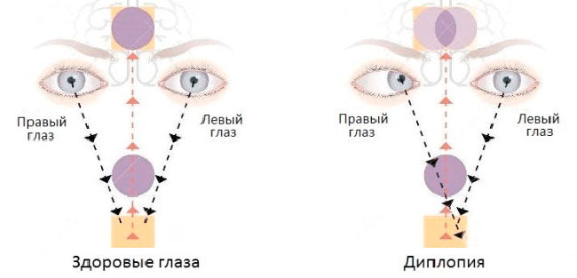 Здоровые глаза и диплопия