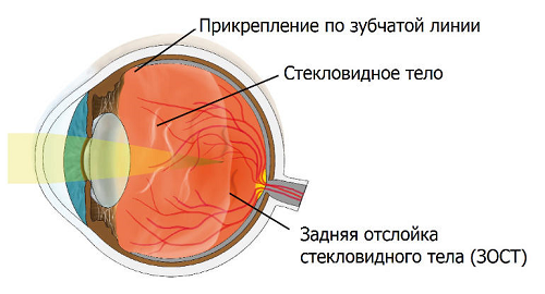 Отслойка стекловидного тела