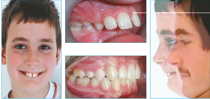 Лечение дистального прикуса зубов. Фото до и после