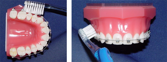 Ухаживание за брекет-системой с использованием зубной щетки