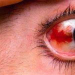 Травматические повреждения глаза