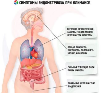 Симптомы эндометриоза при климаксе