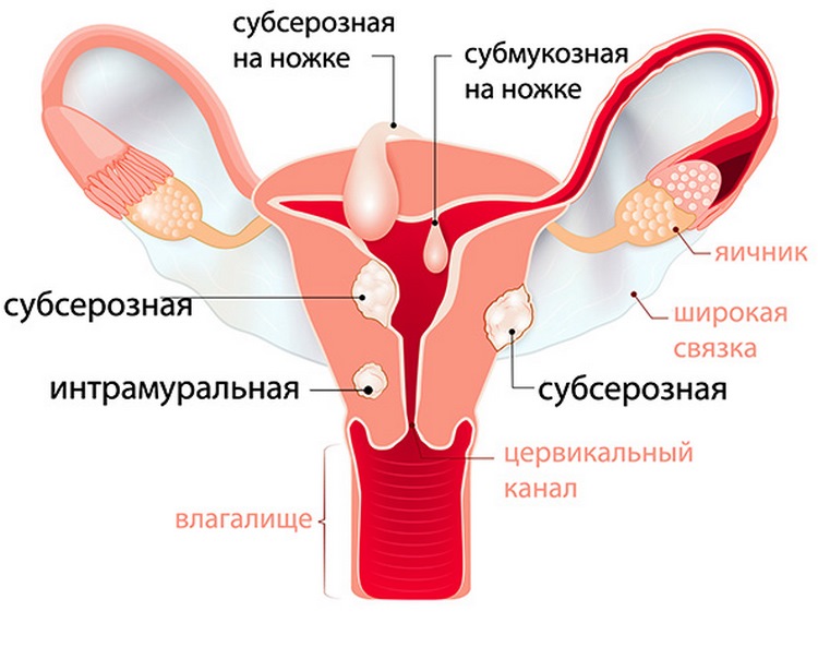 Как проявляется эндометриоз матки на фоне миомы?