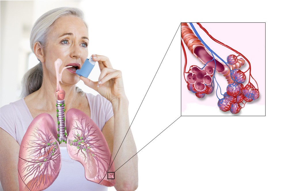 астма бронхиального типа