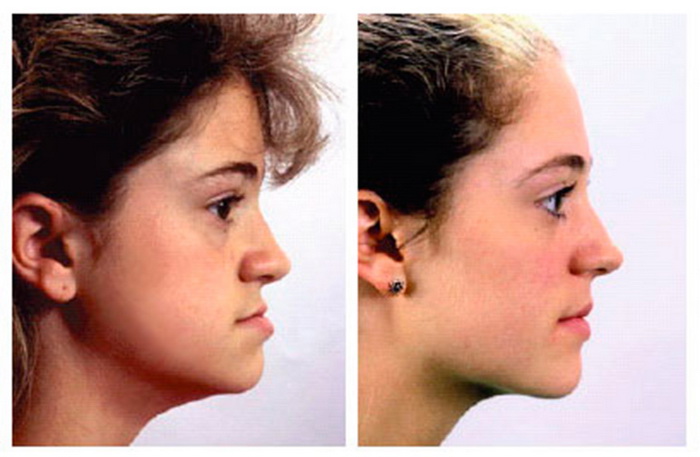 Изменение лица после лечения брекетами. 8 фото ДО и ПОСЛЕ