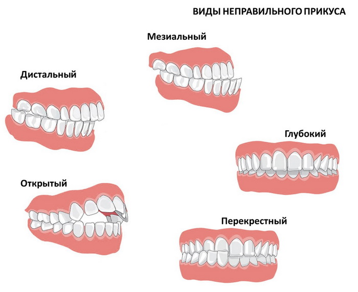Дистальный прикус зубов у детей и взрослых. Характеристики, лечение, профилактика