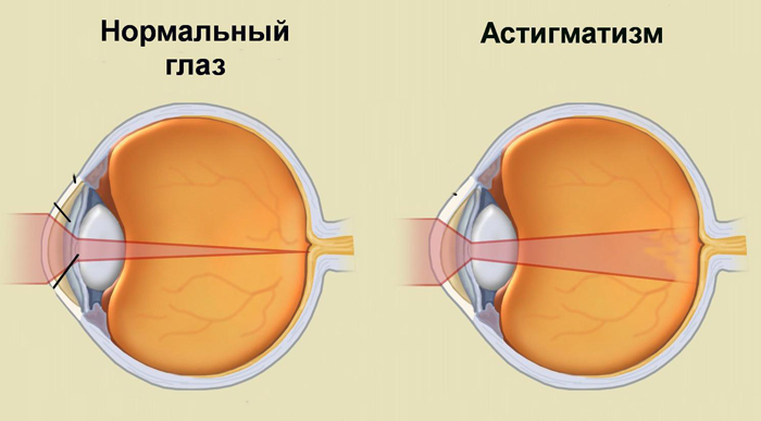 Астигматизм и здоровый глаз