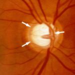 Механизм развития атрофия зрительного нерва