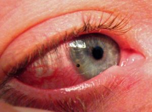 Повреждение роговицы глаза