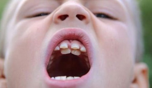 Так выглядит дистопия зубов. В данном случае резцов - они располагаются не на своем месте