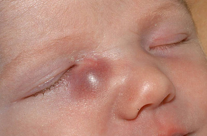 Причины развития Дакриоцистита у новорожденных