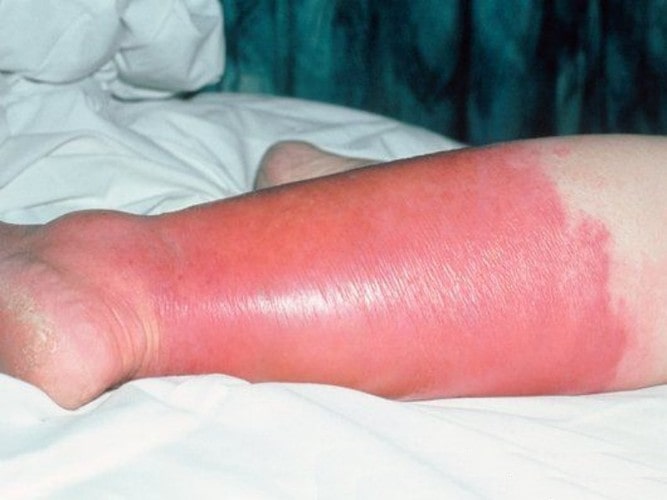 Симптомы рожистого воспаления на ногах