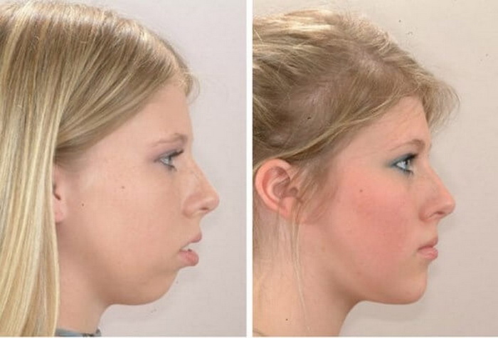 Изменение лица после лечения брекетами. 8 фото ДО и ПОСЛЕ