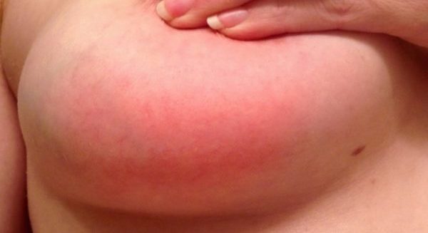 Мастит у женщин при грудном вскармливании: причины и симптомы, лечение и профилактика