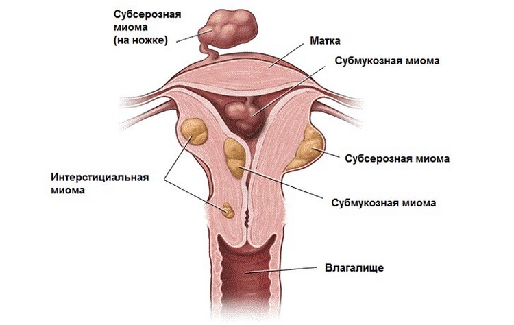 Особенности менструаций при миоме