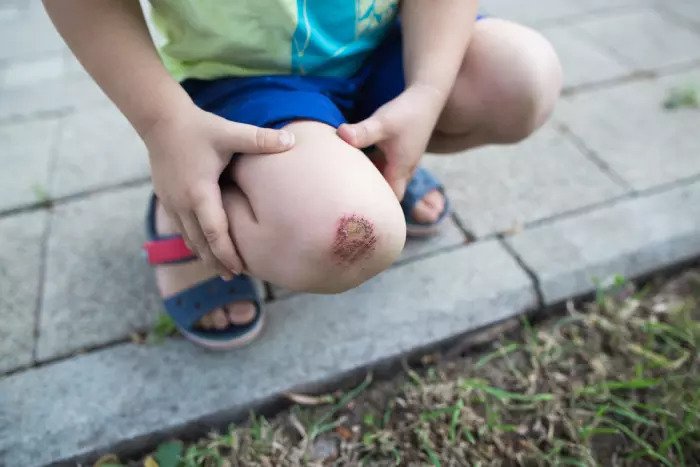 Раненое, кровоточащее колено ребенка