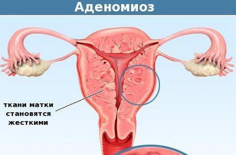 В чем опасность симбиоза миомы матки и аденомиоза?
