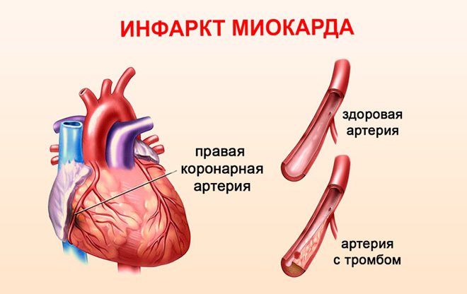 Инфаркта миокарда