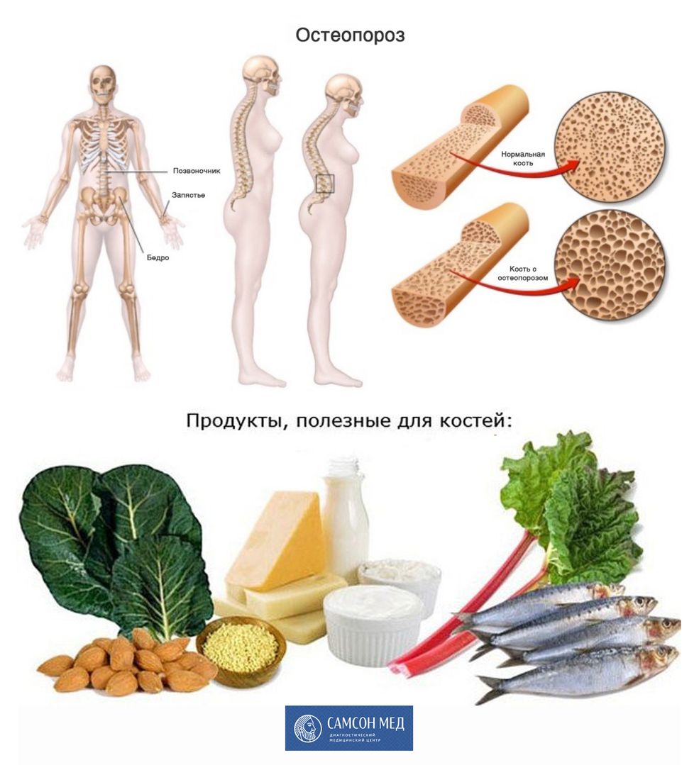 Остеопороз и полезные продукты