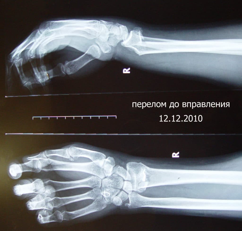 Рентген фото перелом руки
