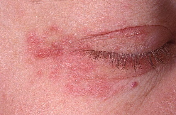 Аллергия на глазах симптомы
