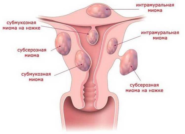 Особенности менструаций при миоме