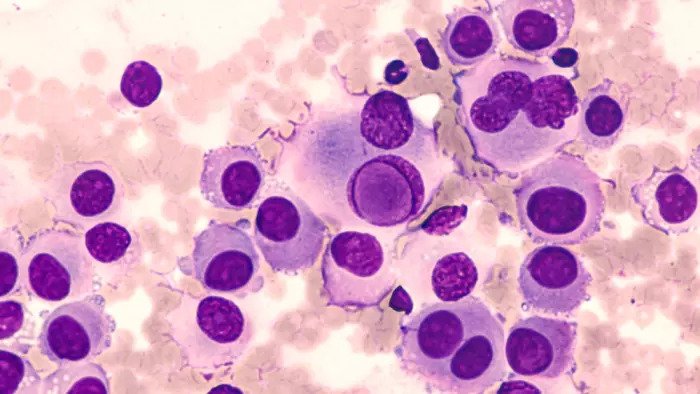 Раковые клетки меланомы