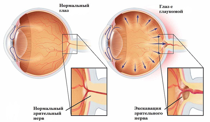 Глаукома