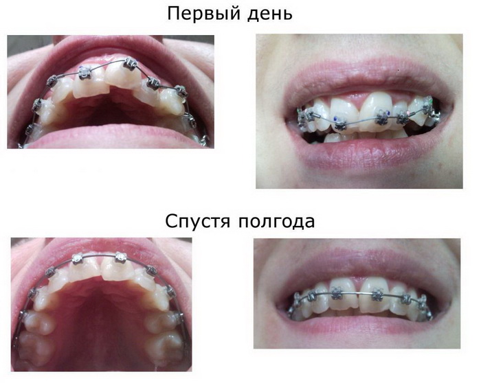 Лечение искривления зубов самолигирующими брекетами. До и после