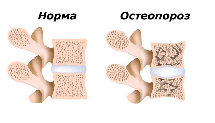 Как предотвратить остеопороз у женщин во время климактерия?
