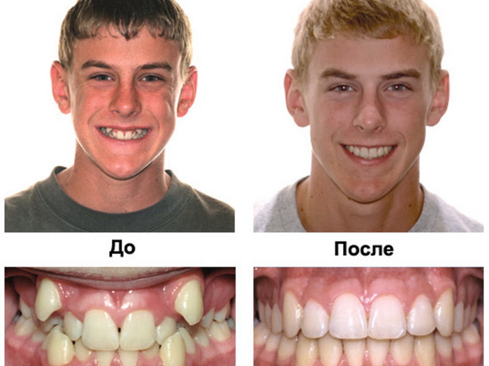 Исправление кривых зубов брекетами ДО и ПОСЛЕ