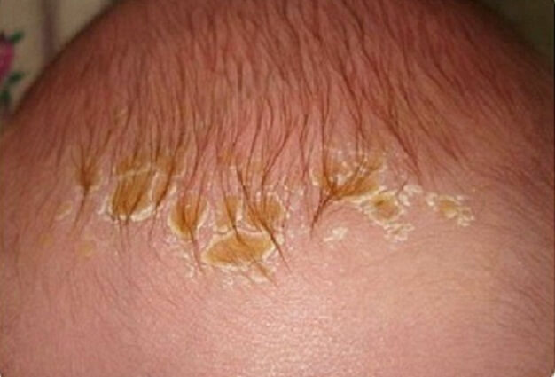 молочные корочки часто появляются на голове и на бровях
