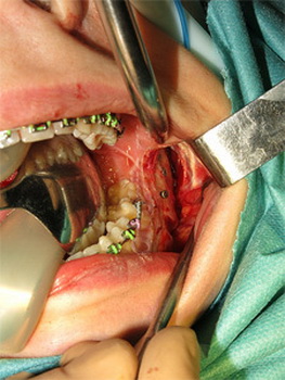 Разрез на левой челюсти пациента - видна лицевая кость