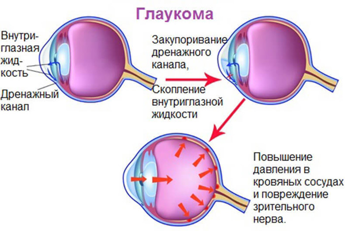 Схема образования глаукомы в глазном яблоке.