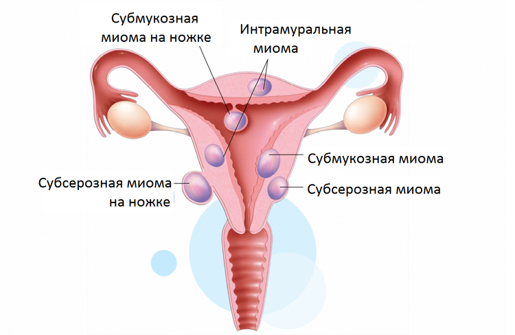Особенности диагностики и лечения миомы матки интрамуральной формы