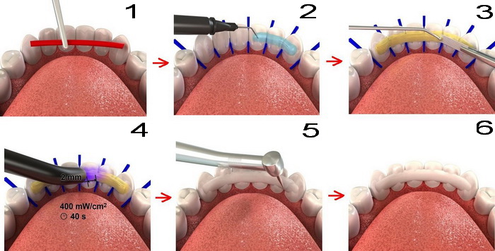 Последовательность установки несъемного зубного ретейнера