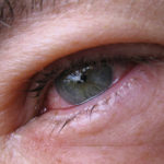 Эписклерит глаза: симптоматика и причины возникновения заболевания, методы лечения