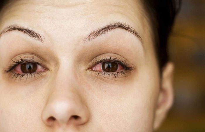 Как снять воспаление глаз в домашних условиях