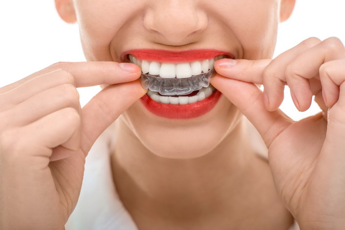 Элайнеры для выравнивания зубов. Предназначение, особенности ухода и эксплуатации