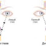 Здоровые глаза и диплопия